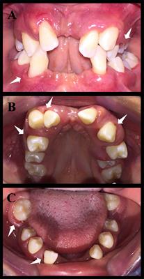 Oral Phenotype and Salivary Microbiome of Individuals With Papillon–Lefèvre Syndrome